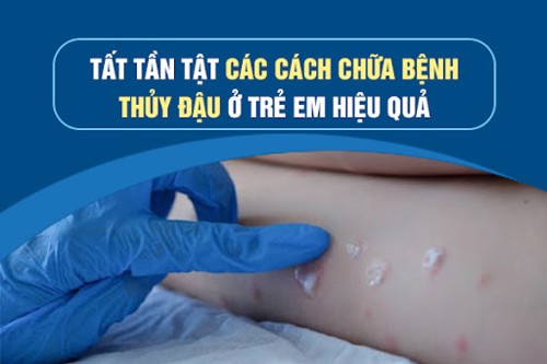 Tất tần tật các cách chữa bệnh thủy đậu ở trẻ em hiệu quả